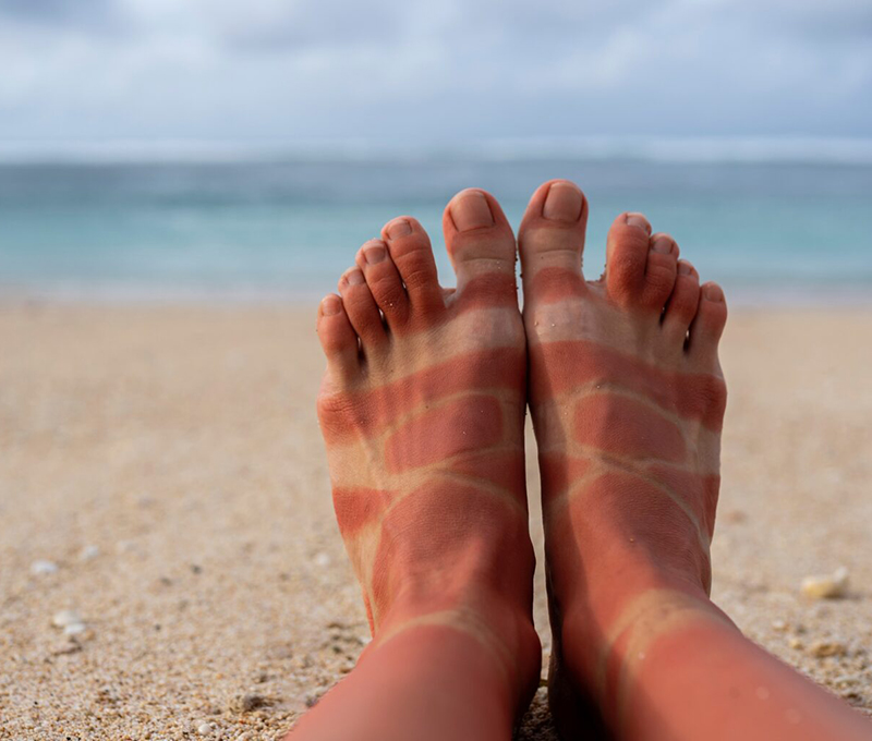 0 Cáncer piel cambio climático