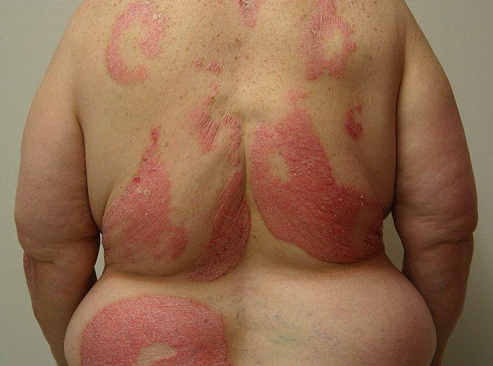 3 Obesidad psoriasis grave