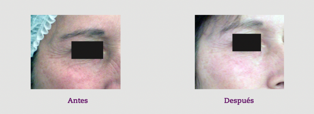 14 ácido hialurónico arrugas CHFI18