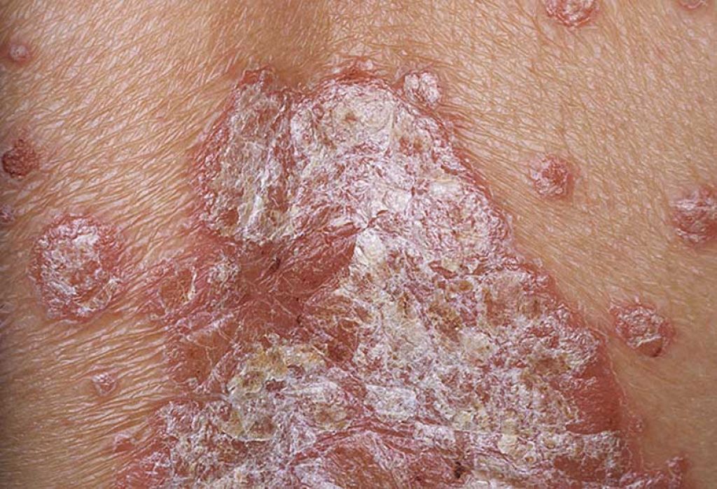 5 Obesidad psoriasis grave