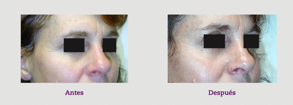 11 ácido hialurónico arrugas CHFI18