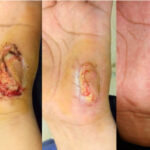 0 Eficacia desbridamiento enzimático