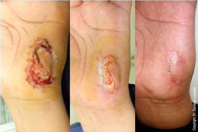 0 Eficacia desbridamiento enzimático