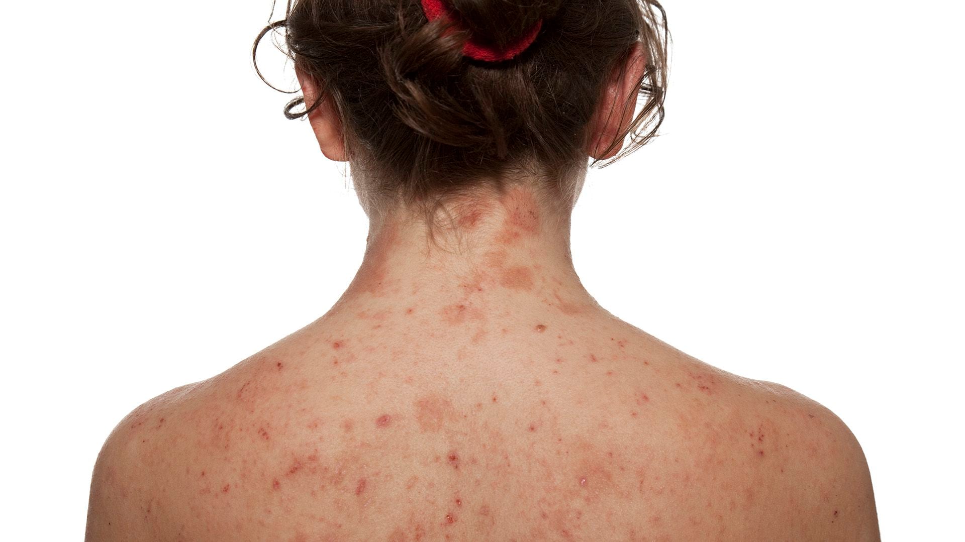 0 Guías dermatitis atópica