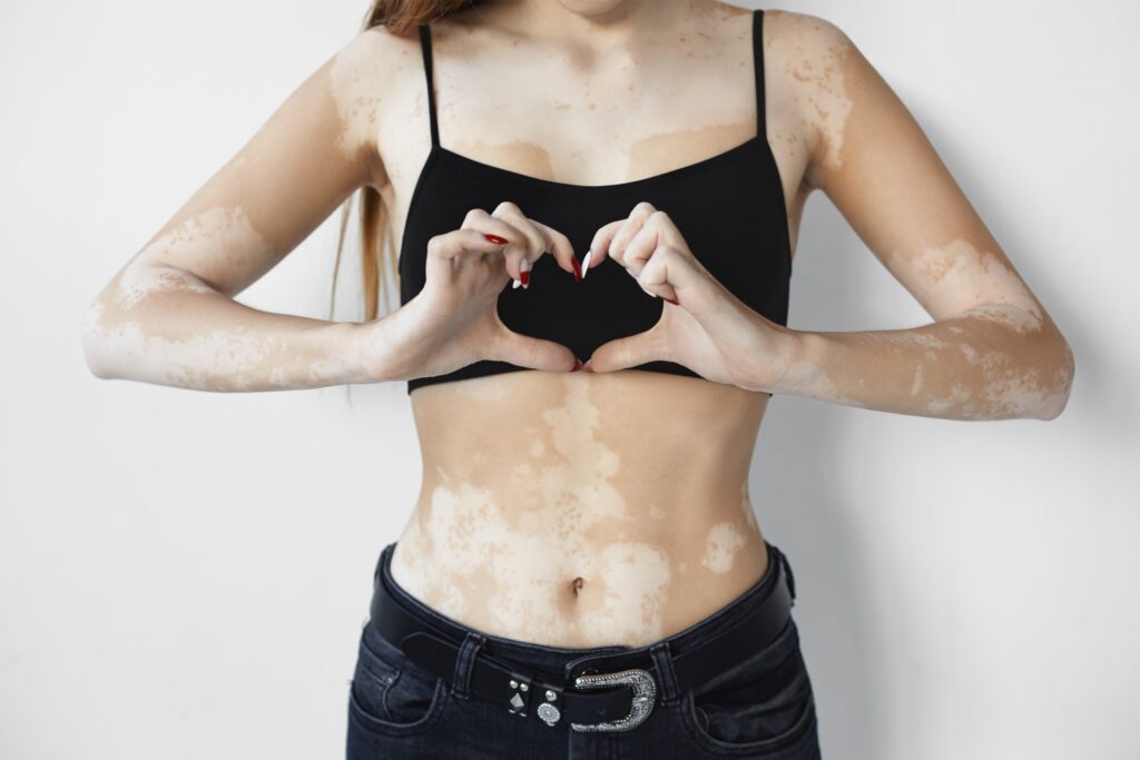 0 Vitiligo etiopatogenia avances