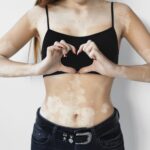 0 Vitiligo etiopatogenia avances