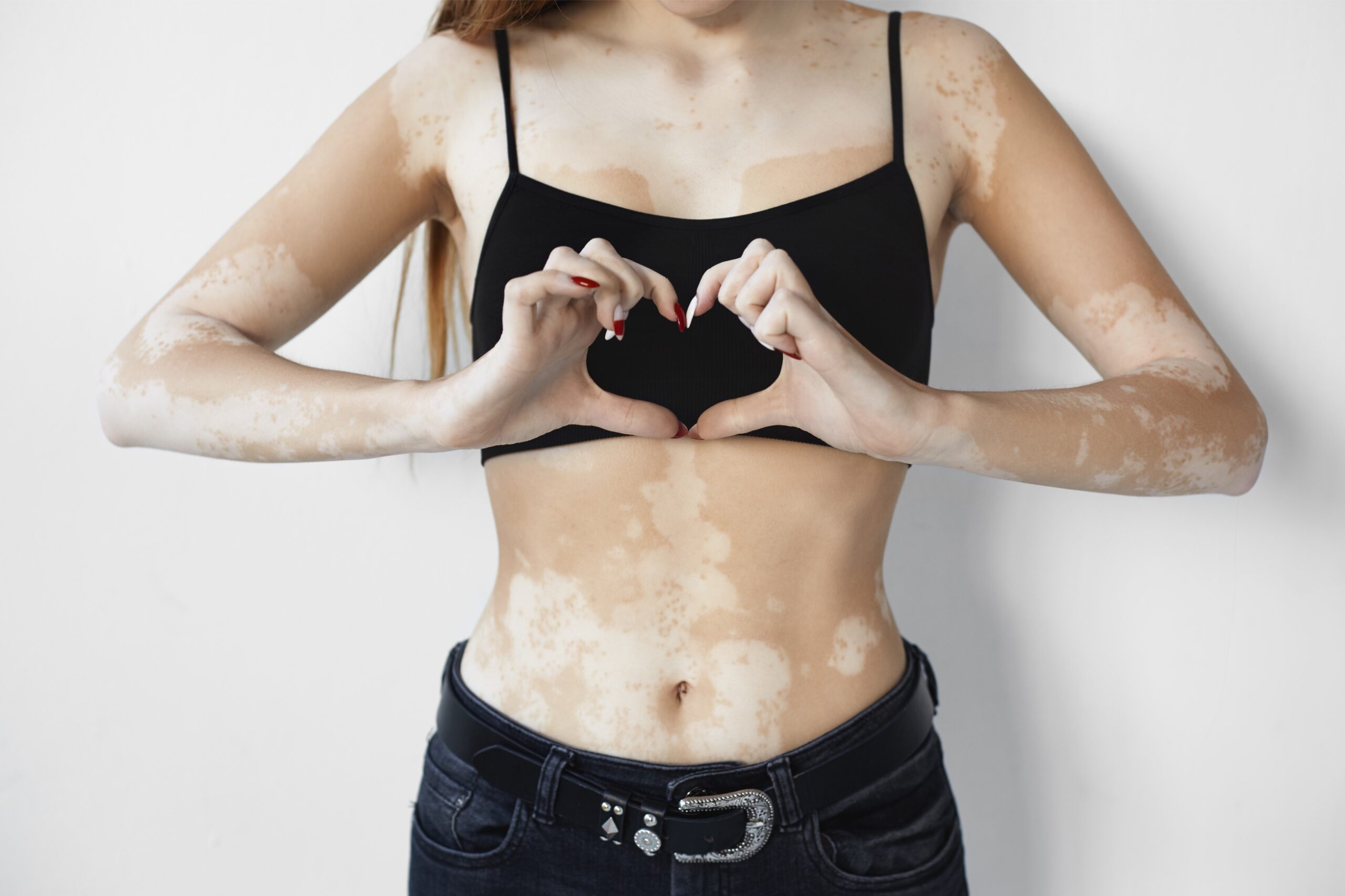 0 Vitiligo etiopatogenia avances