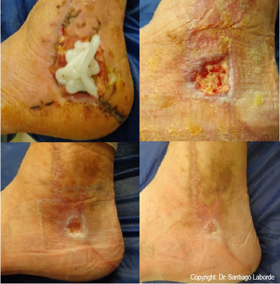 1 Eficacia desbridamiento enzimático