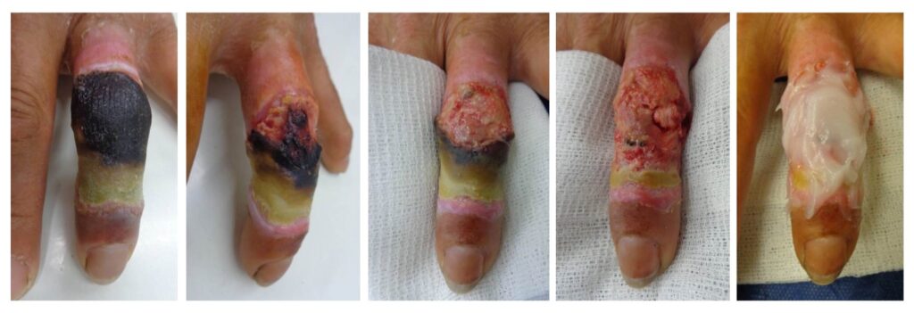 2 Eficacia desbridamiento enzimático