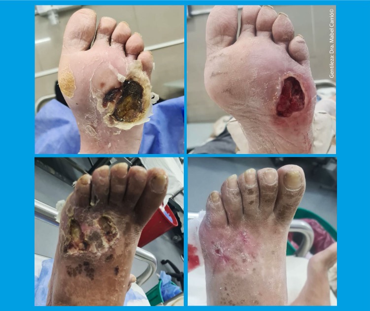 3 Eficacia desbridamiento enzimático