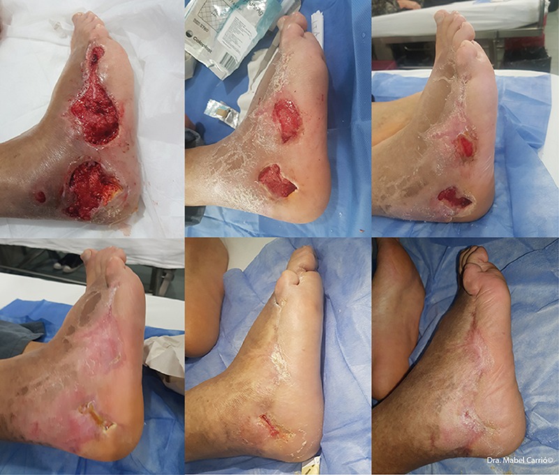 5 Eficacia desbridamiento enzimático