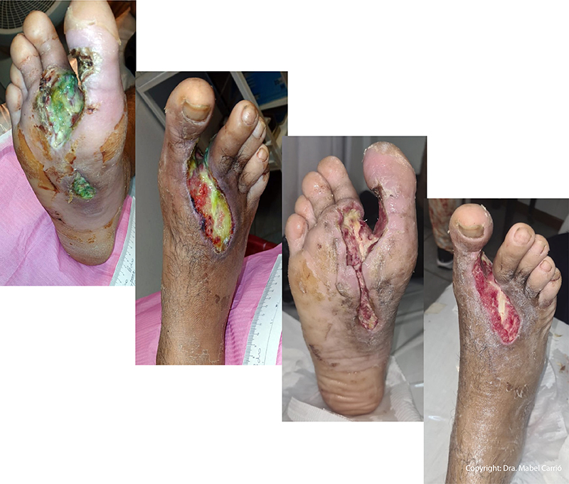 6 Eficacia desbridamiento enzimático