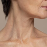 0 Ácido hialurónico HSBL32