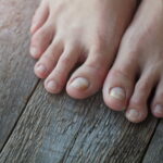 0 Diabetes onicomicosis abordaje