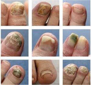 0 Onicomicosis y diabetes