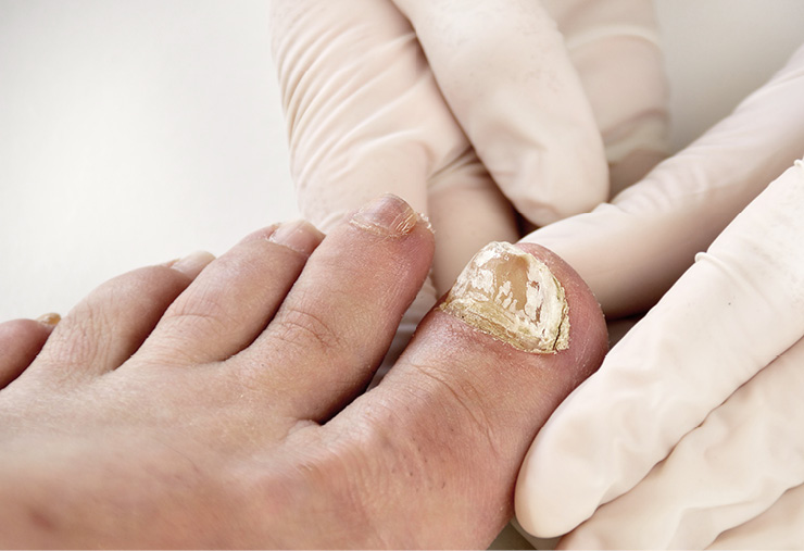 1 Diabetes onicomicosis abordaje