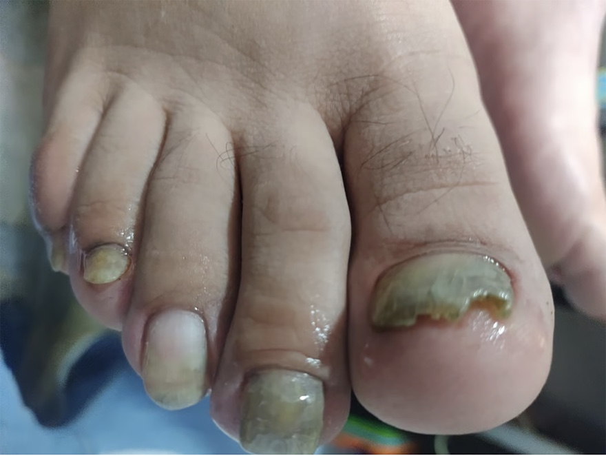 1 Onicomicosis y diabetes