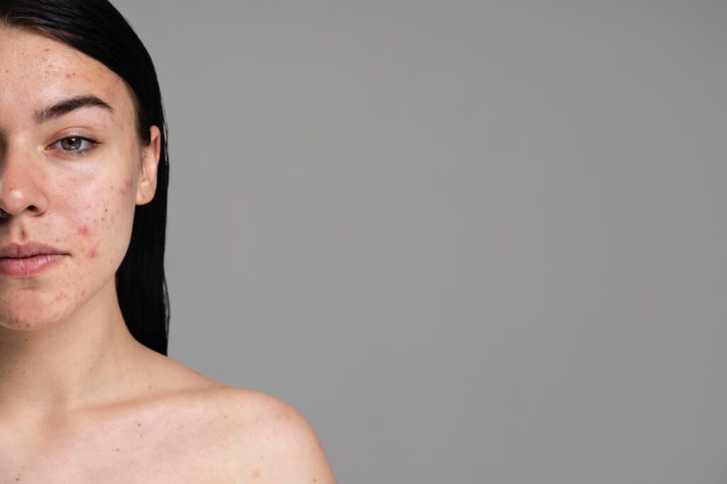 2 Acné Consenso antibióticos