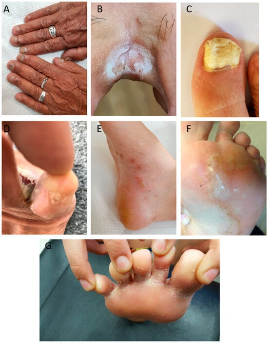 3 Diabetes onicomicosis abordaje