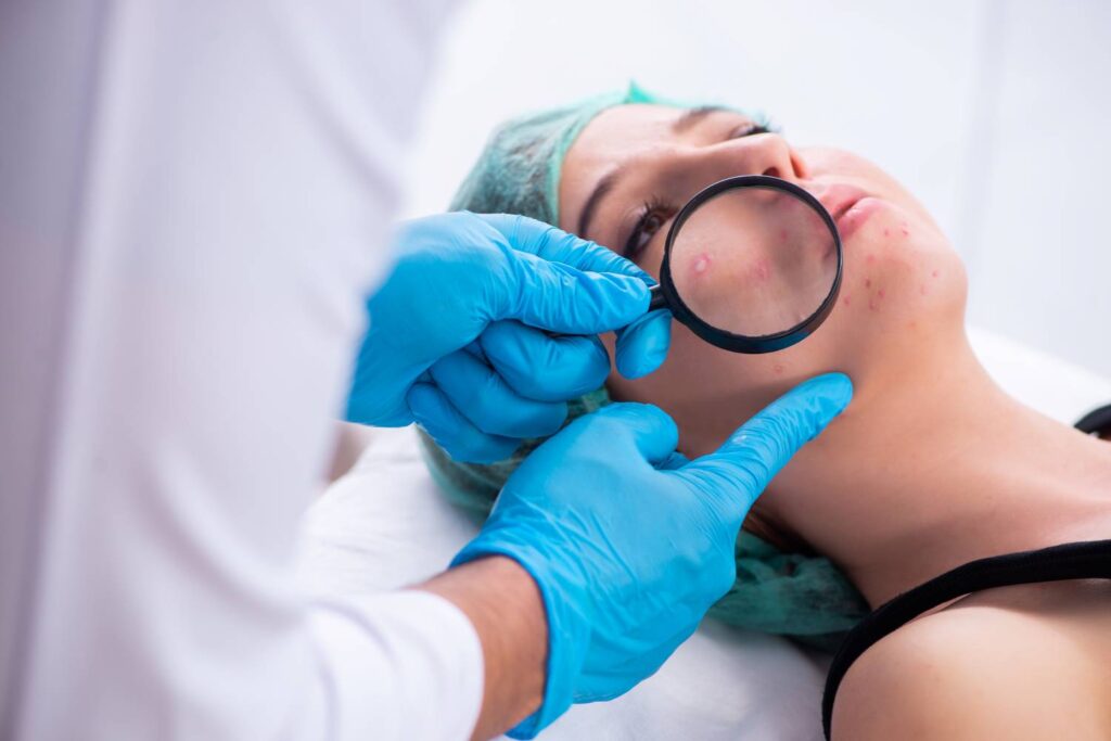 4 Acné Consenso antibióticos