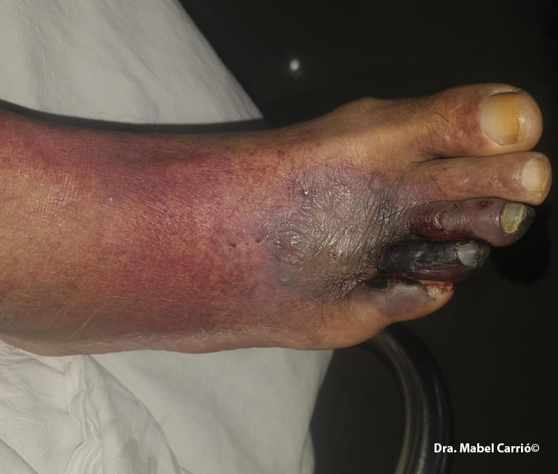 4 Onicomicosis y diabetes