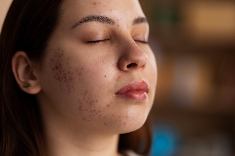 5 Acné Consenso antibióticos