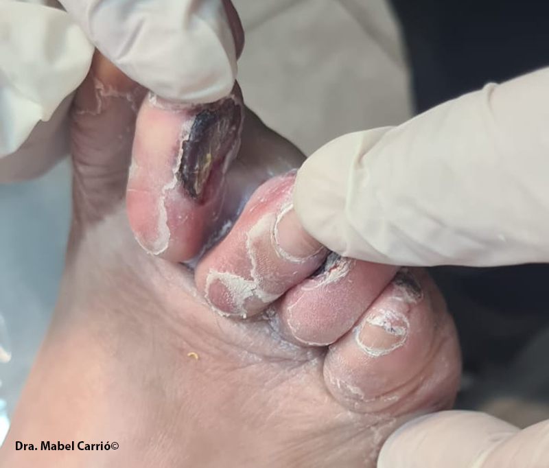 5 Onicomicosis y diabetes