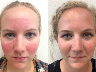 5 Rosácea síndrome metabólico