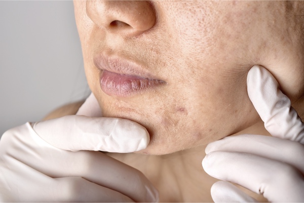 6 Acné Consenso antibióticos