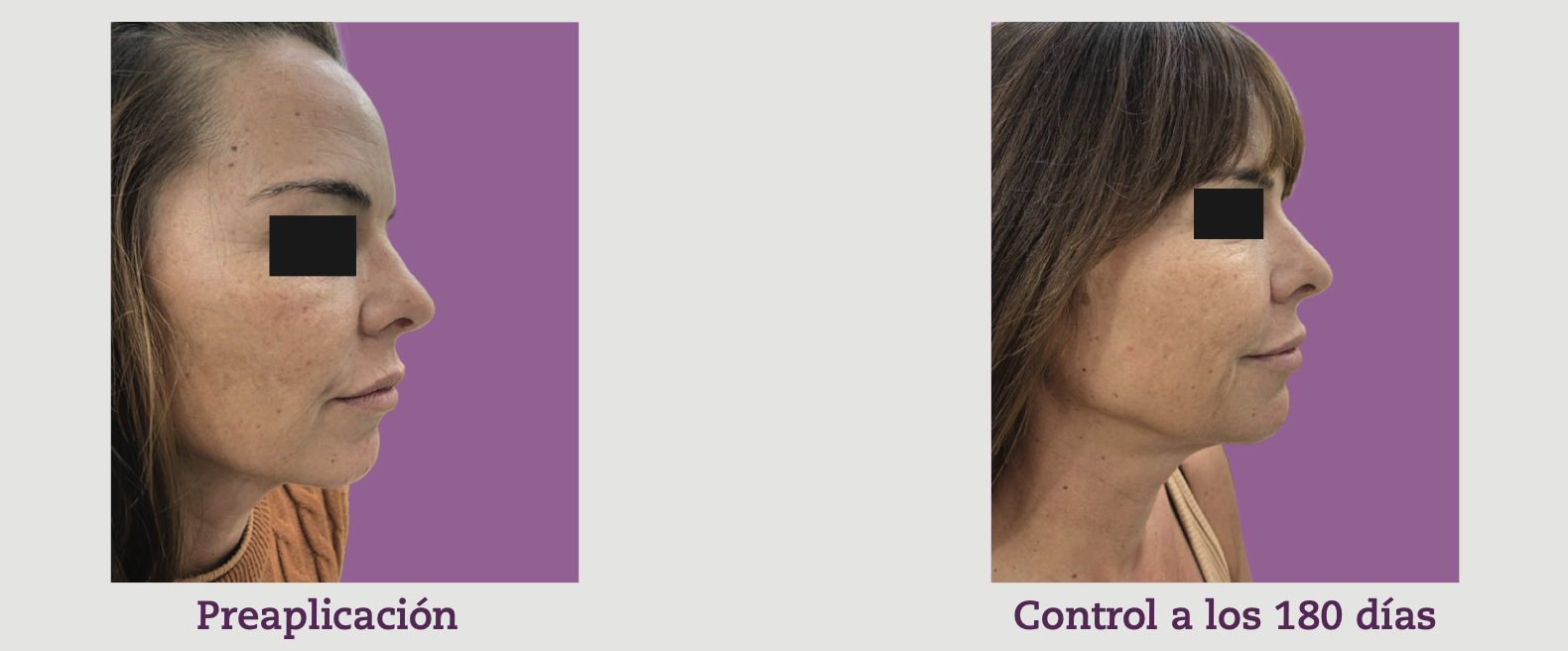 6 Ácido hialurónico HSBL32