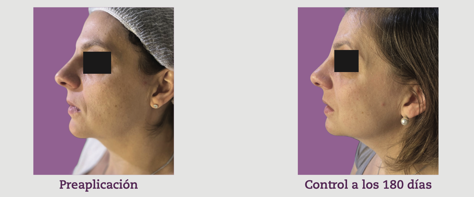 7 Ácido hialurónico HSBL32