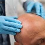 0 Alopecia inducida por fármacos