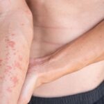 0 Dermatitis atópica comorbilidades alérgicas