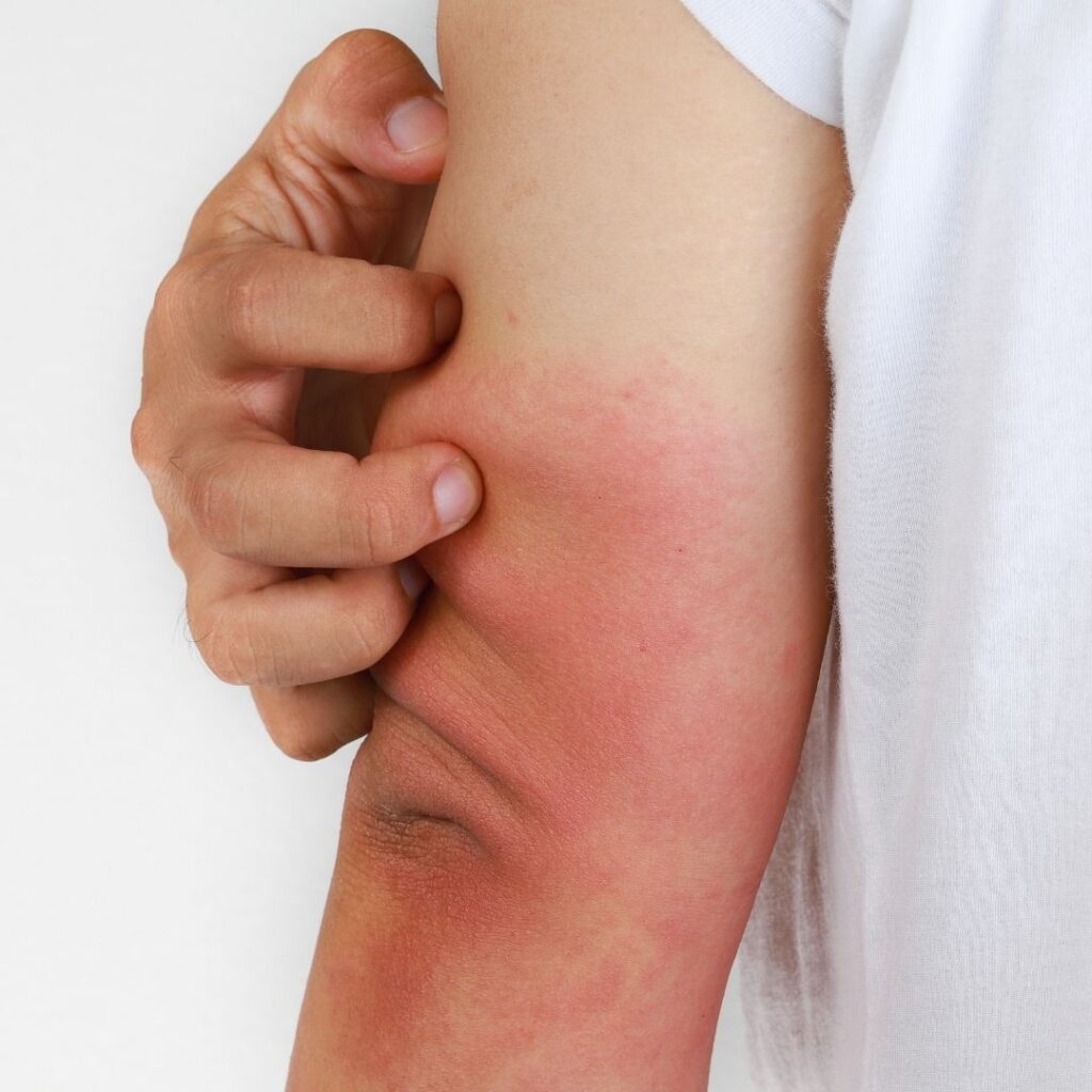 1 Dermatitis atópica comorbilidades alérgicas