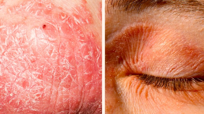 1 Gluten manifestaciones cutáneas