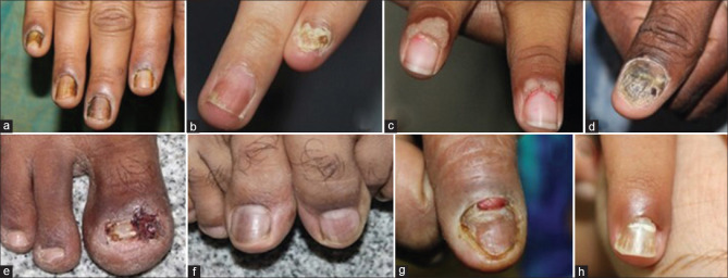 1 Láser enfermedades uñas