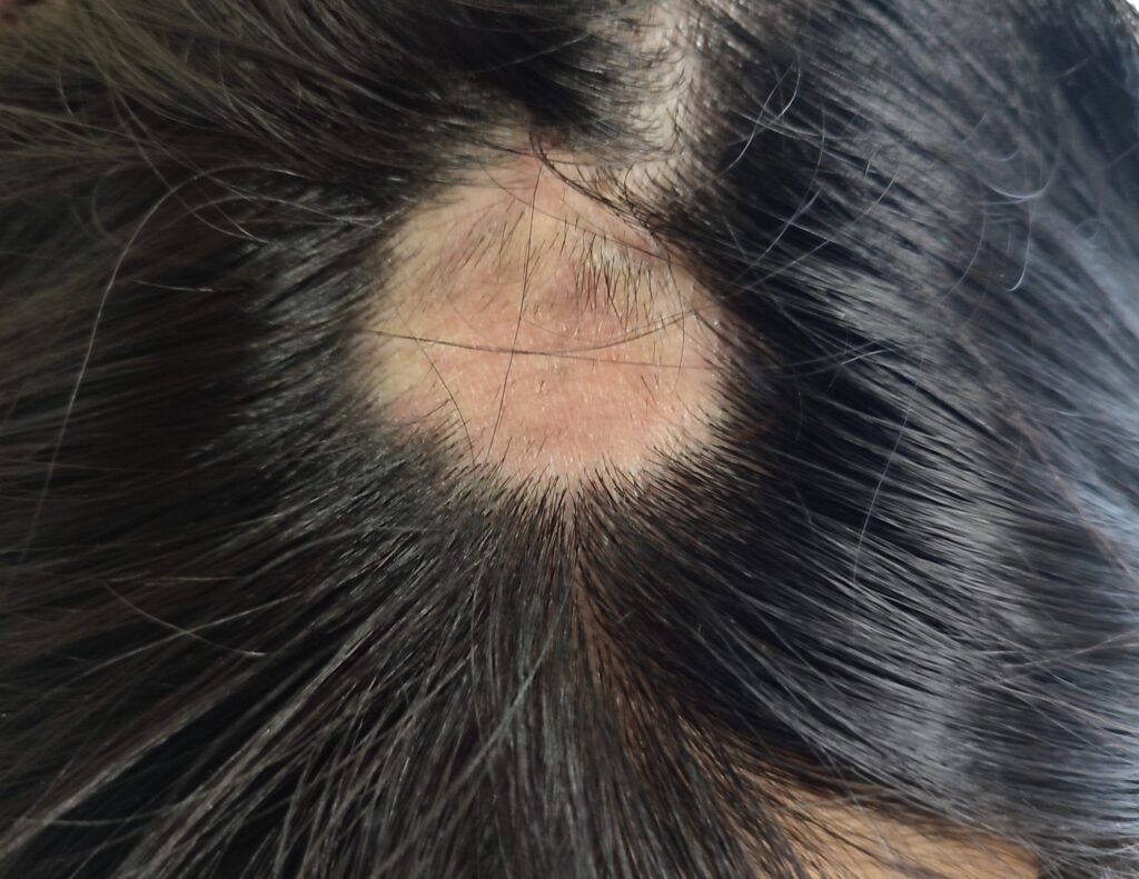 1 Microbioma cuero cabelludo alopecia