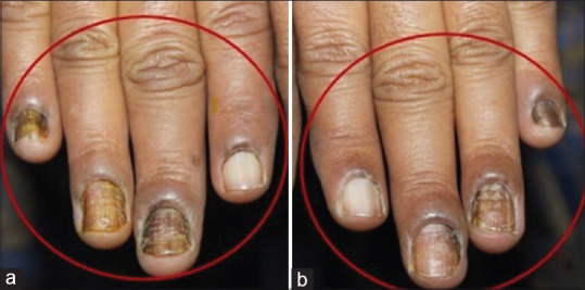 2 Láser enfermedades uñas