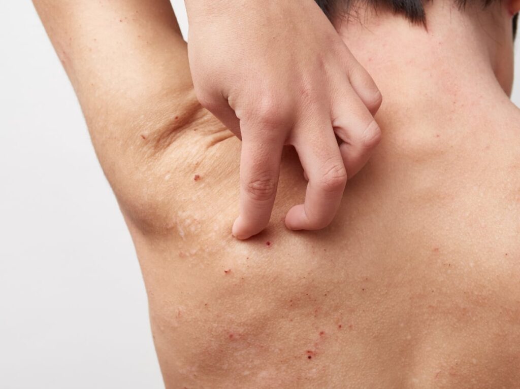 3 Dermatitis atópica comorbilidades alérgicas