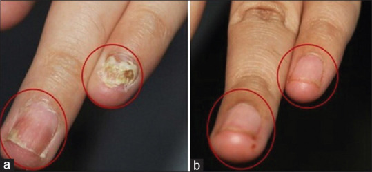 3 Láser enfermedades uñas