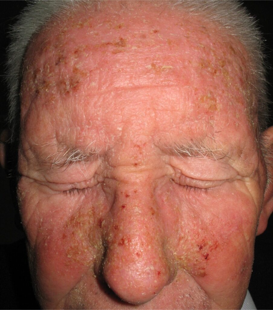 3 Manifestaciones cutáneas Parkinson