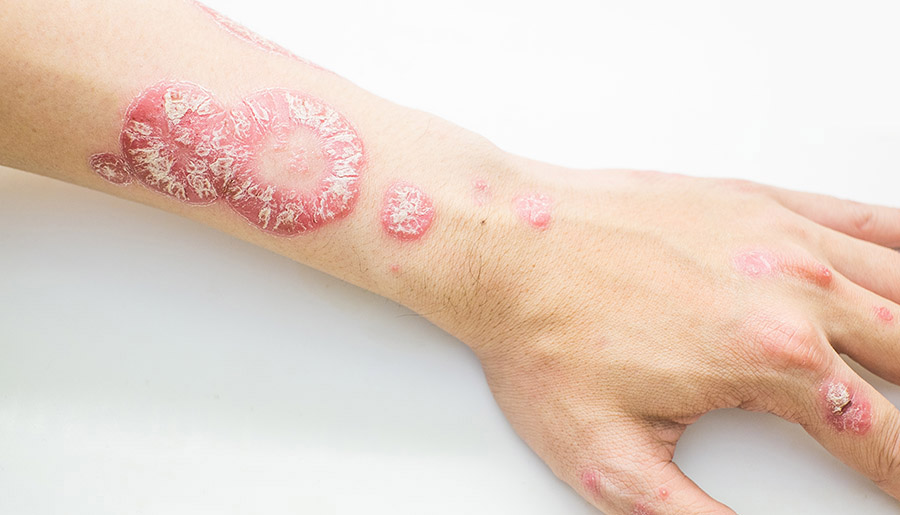 5 Dermatitis seborreica terapias emergentes