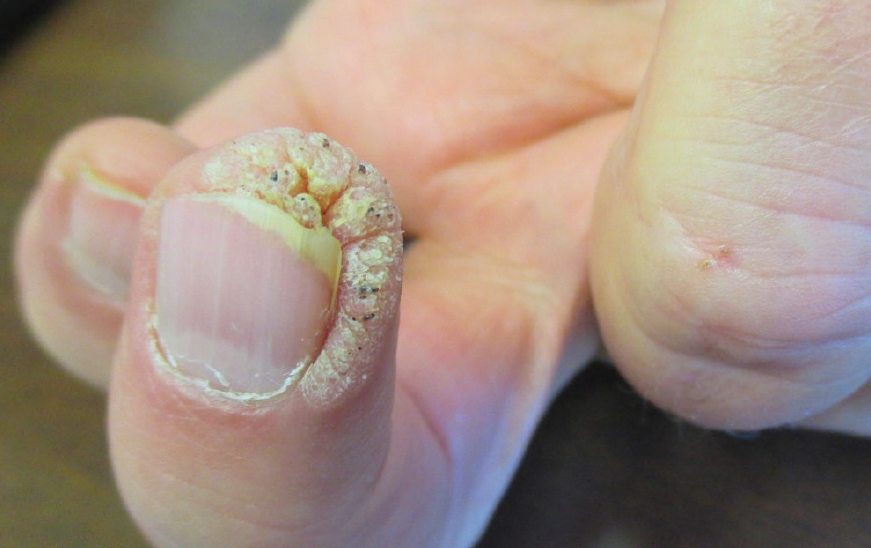 5 Láser enfermedades uñas