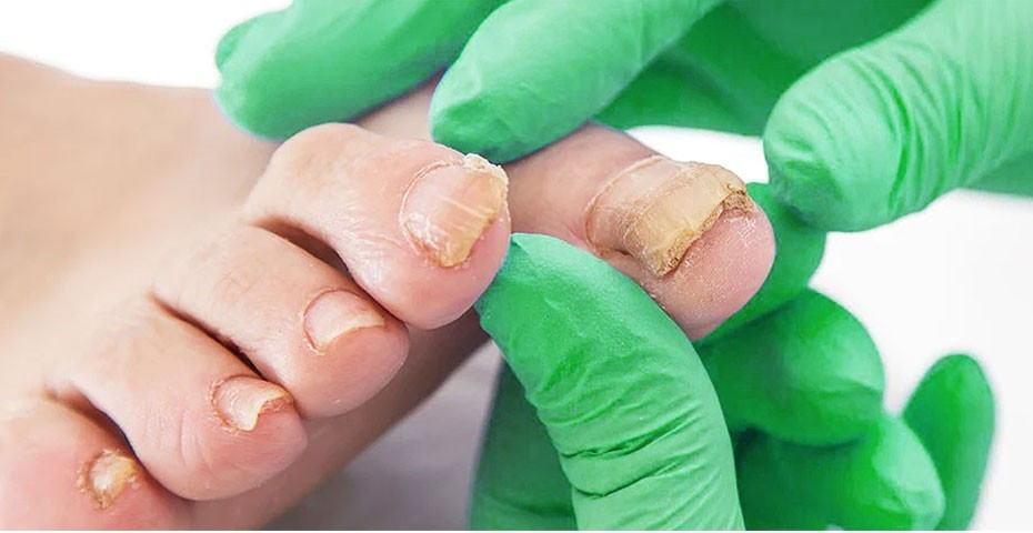 6 Láser enfermedades uñas