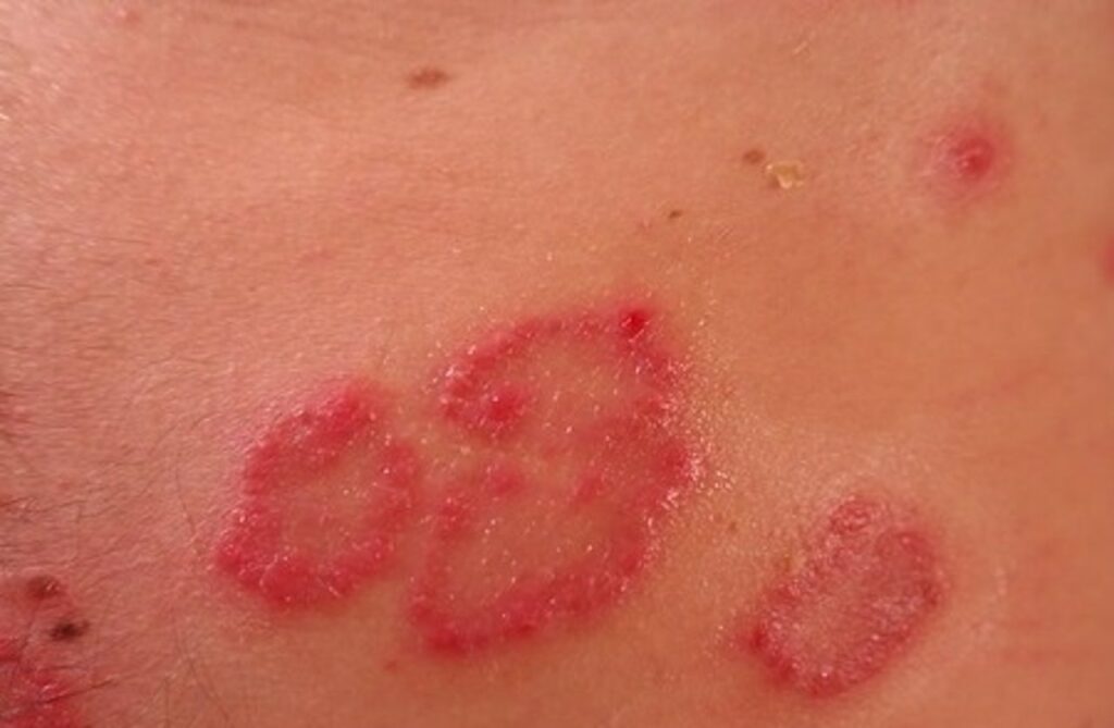 7 Gluten manifestaciones cutáneas