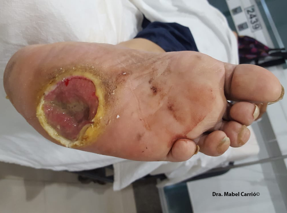 7 SmartBoot úlceras pie diabético