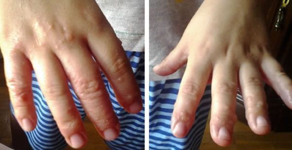 8 Gluten manifestaciones cutáneas