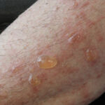 0 Diagnóstico enfermedades ampollares