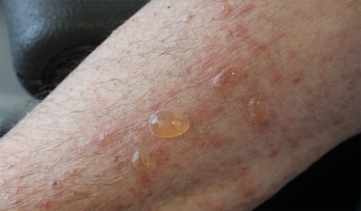 0 Diagnóstico enfermedades ampollares