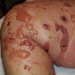 0 Enfermedades ampollares subepidérmicas autoinmunes